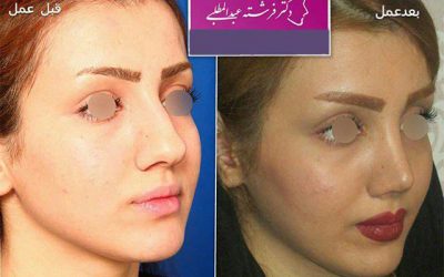 جراحی بینی به روش باز