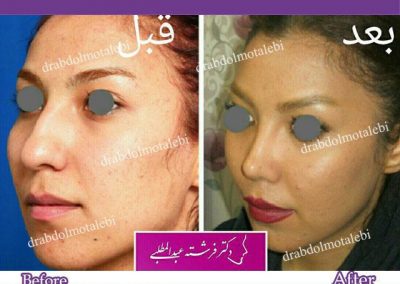 جراحی بینی زنان و عوارض آن