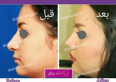 تغییرات زنان با جراحی بینی