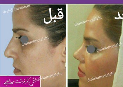 قبل و بعد از جراحی بینی