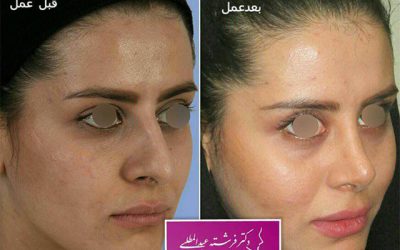 استحمام پس از جراحی بینی