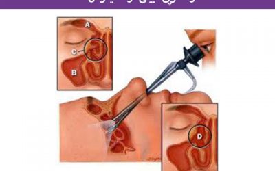 آندوسکوپی