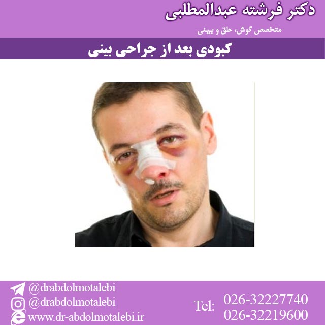 کبودی-بعد-از-جراحی-بینی