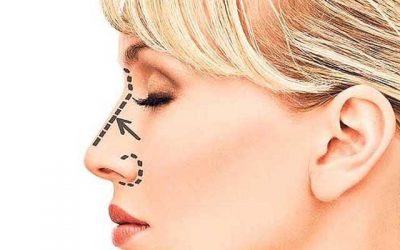 موفقیت در جراحی بینی