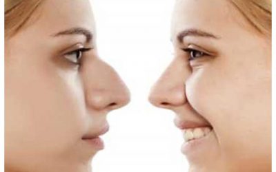 جراحی قوز بینی