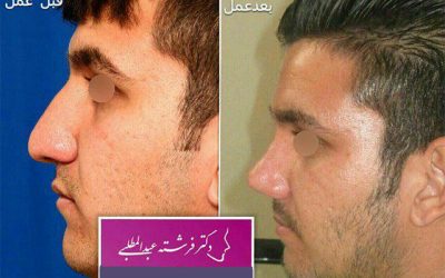 جراحی بینی مردانه