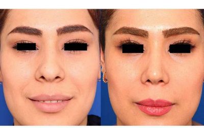 جراحی بینی پهن