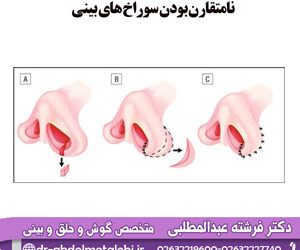 نامتقارن بودن سوراخ های بینی