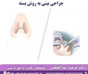 جراحی بینی به روش بسته