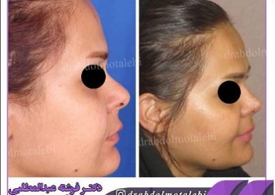 بینی بعد از عمل - جراحی زیبایی بینی