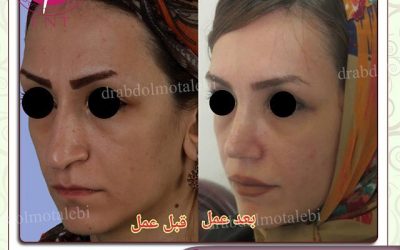 آیا کم خونی در عمل بینی تاثیر دارد؟