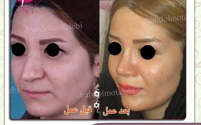 نکاتی مهم درباره جراحی بینی