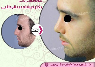 جراحی زیبایی بینی - مردان در کرج