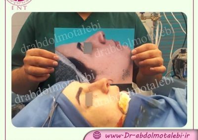 نمونه جراحی بینی در اتاق عمل توسط خانم دکتر عبدالمطلبی