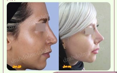 عمل ترمیم بینی، نتیجه خوبی دارد؟