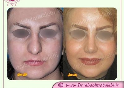 نمونه کار جراحی بینی زنانه قبل و بعد