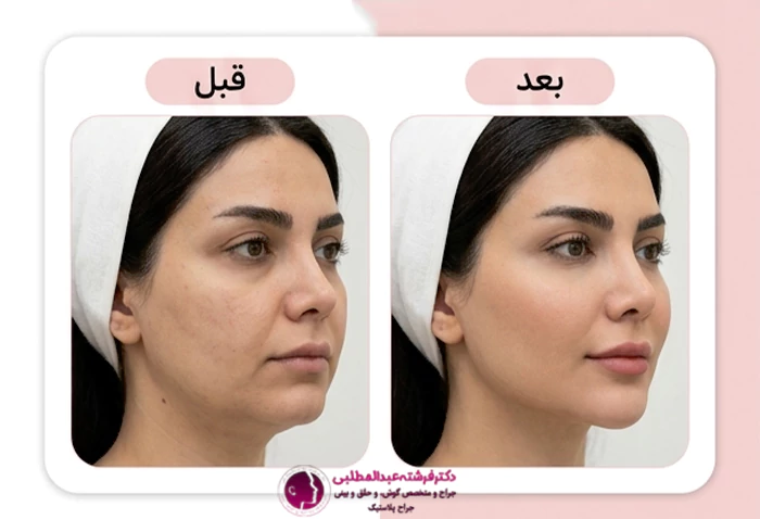عکس قبل و بعد هایفو